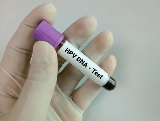 Cervical Cancer - Human Papillomavirus DNA Test