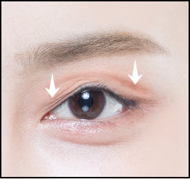 Step 1 of the brow lift procedure