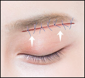 3 steps to the brow lift procedure