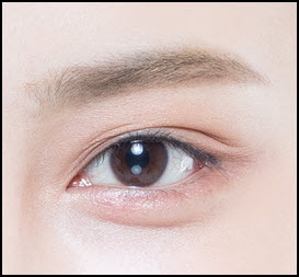 4 steps in the brow lift procedure