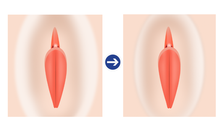 Labiaplasty reduction