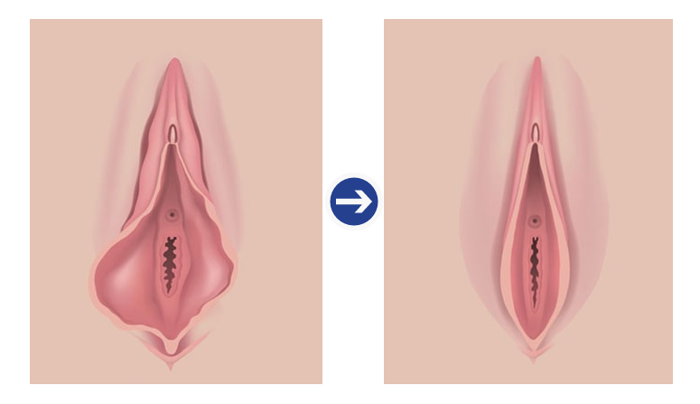 Labiaplasty augmentation