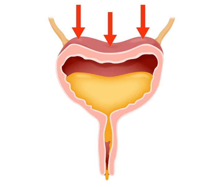 Stress Incontinence
