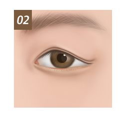 Lower Blepharoplasty Candidates 2