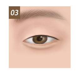 Lower Blepharoplasty Candidates 3