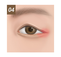Lower Blepharoplasty Candidates 4