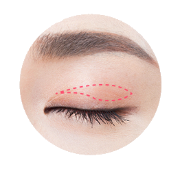Upper Blepharoplasty Procedure 1