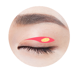 Upper Blepharoplasty Procedure 2