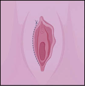 Cut one side of a labioplasty
