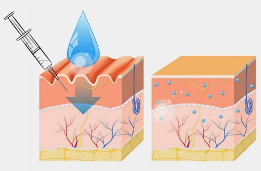 Step 3 of the Skin Booster process