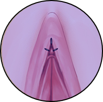 Clitoroplasty sutures