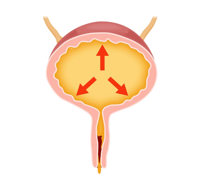 Overflow Incontinence