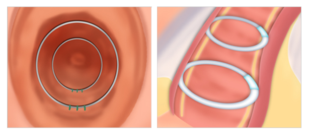 O-O shaped implant vaginoplasty