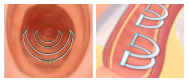 U-U shaped implant vaginoplasty