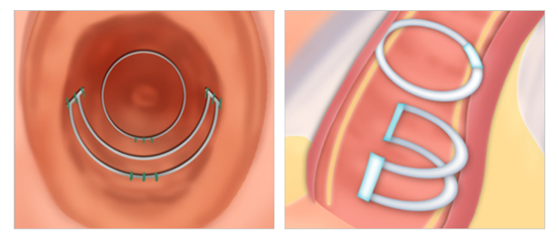 U-O shaped implant vaginoplasty