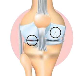 Autologous Bone Marrow Stem Cell KL Grade 2