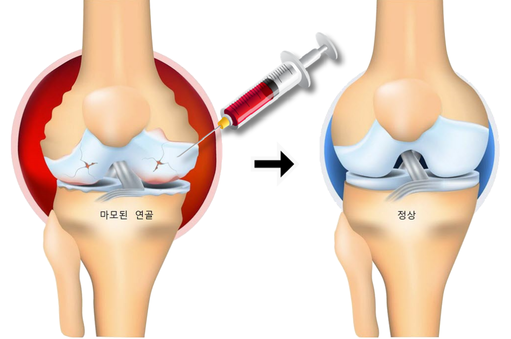 자가골수 줄기세포 치료 The effects of autologous bone marrow stem cell therapy