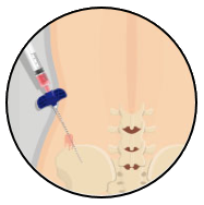 Autologous Bone Marrow Stem Cell Procedure 1