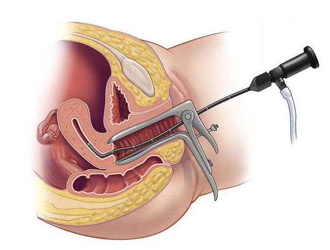 Colposcopy for cervical cancer
