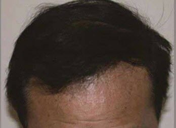 After Stem Cell Hair Loss Treatment