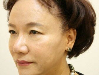After a stem cell anti-aging treatment procedure