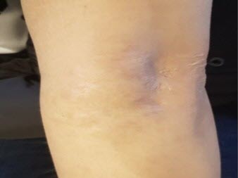 After stem cell burn scar treatment