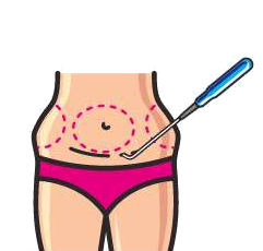 Liposuction Thread Progression 3