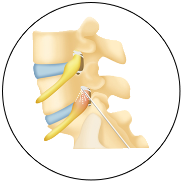 3 steps in the balloon augmentation procedure