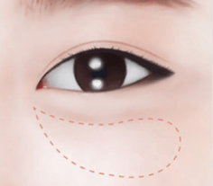 Lower Blepharoplasty Procedure 1