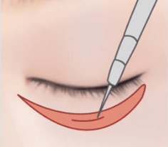 Lower Blepharoplasty Procedure 2