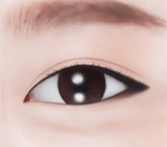 Lower Blepharoplasty Procedure 4