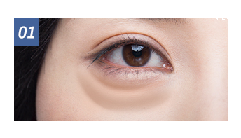 Lower Blepharoplasty Dark Circles 1