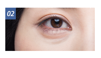 Lower Blepharoplasty Dark Circles 2
