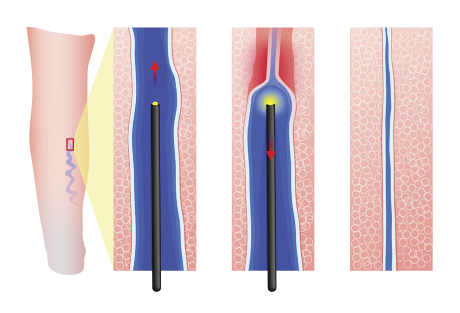 Laser for Venous Insufficiency