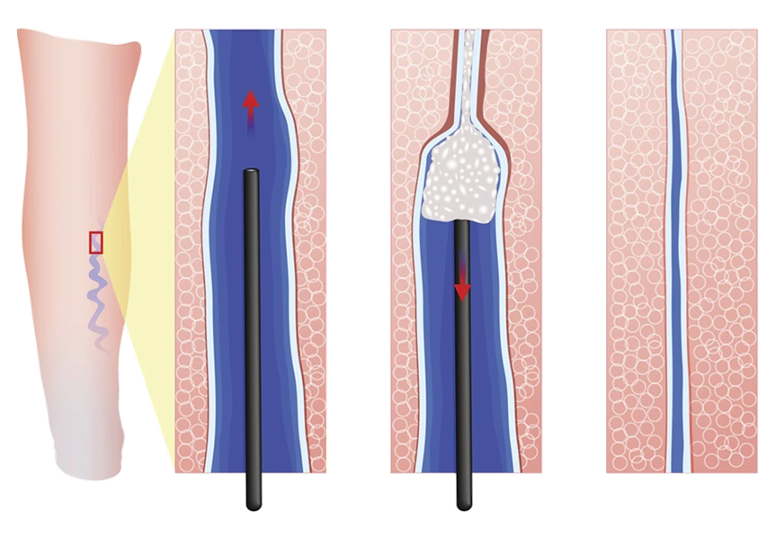 Lower Extremity Venous Insufficiency Angiosclerosis Injection