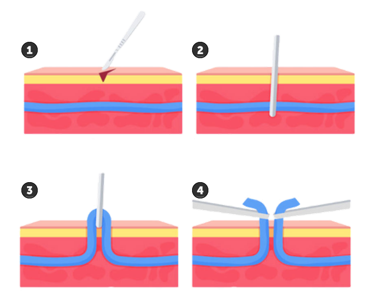 Focal ablation of lower extremity venous insufficiency