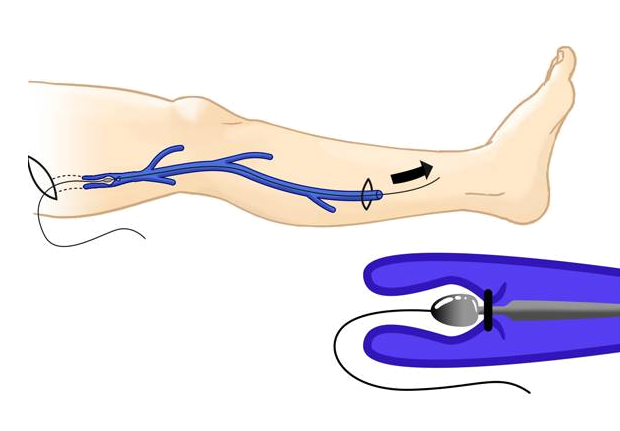 Lower Extremity Venous Insufficiency Harvesting