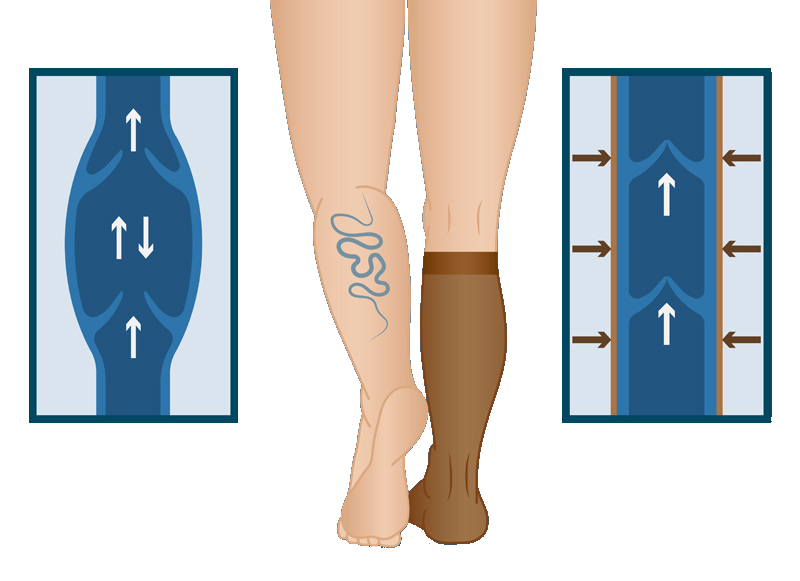 Compression Stockings for Venous Insufficiency