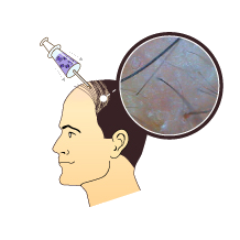 Stem Cell Therapy for Hair Loss