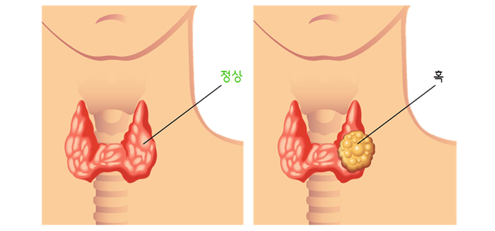 Thyroid nodules