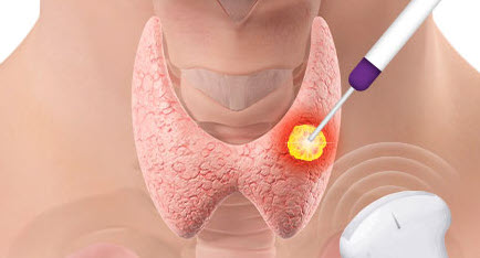 Thyroid Radiofrequency Ablation Procedure Step 1