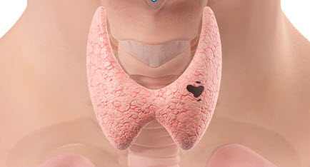 3 steps to the thyroid radiofrequency ablation procedure