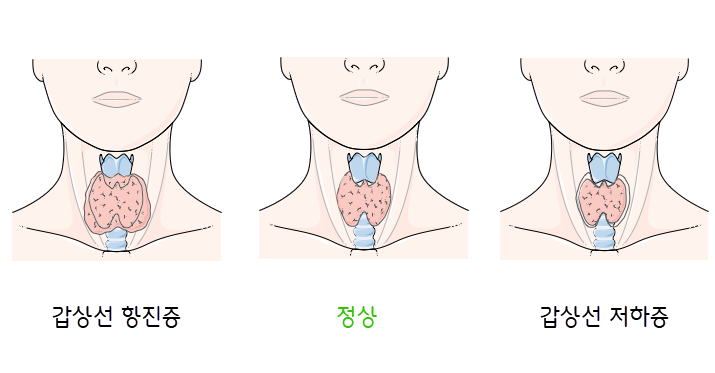 Hyperthyroidism vs hypothyroidism