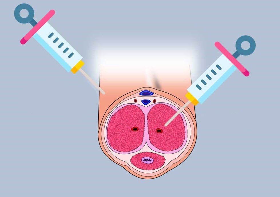Stem Cell Therapy Improves Male Sexual Function