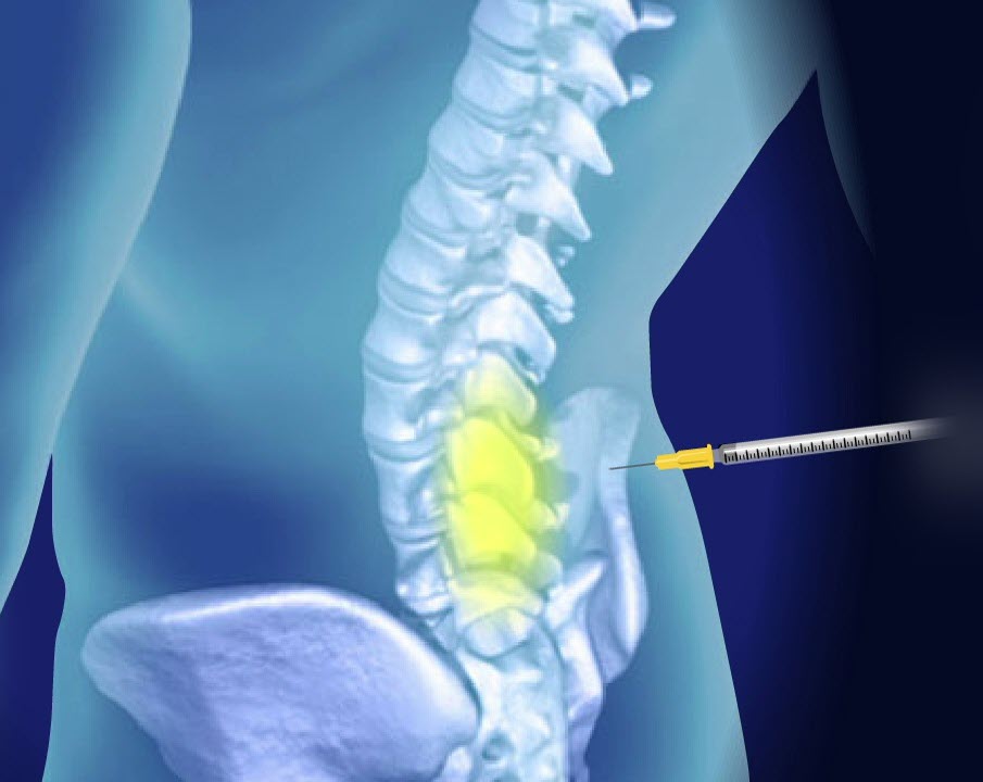 Prolotherapy
