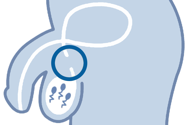 Thumbnail of an unprotected tube surgery