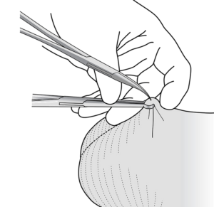 Shameless Tubal Surgery - Procedure STEP 2