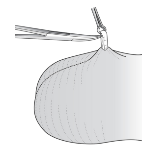 Shameless Tubal Surgery - Procedure STEP 3