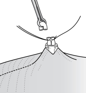 Shameless Tubal Surgery - Procedure STEP 4