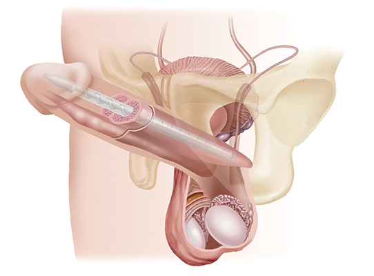After the Malleable Penile Implant Procedure